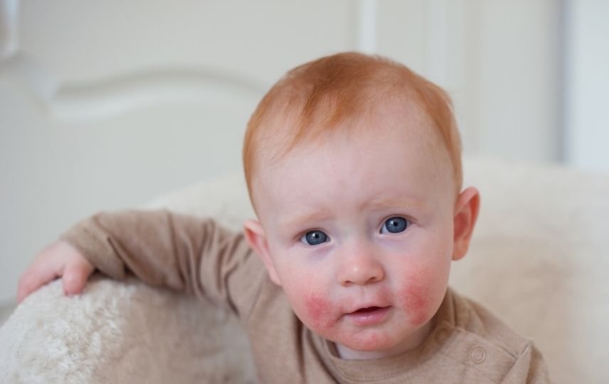 Bebek ve Çocuklarda Kontakt Dermatit